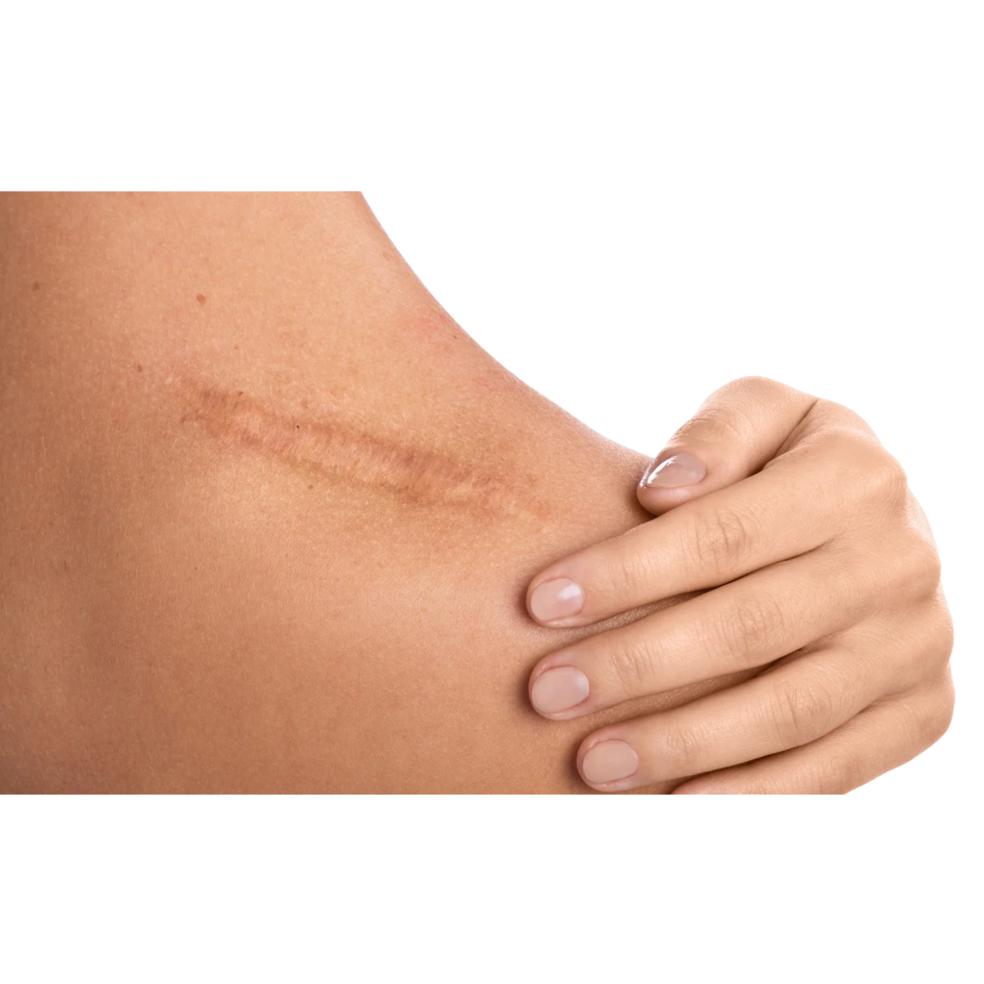 Huile de soin - Cica7 - Zones Cicatricielles - Roll-On - Eona - My Médical